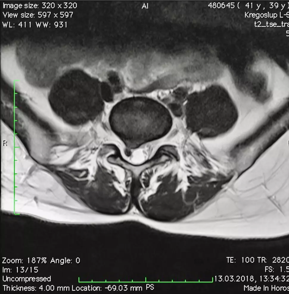 Radiologiczny aspekt gojenia krążka międzykręgowego usg