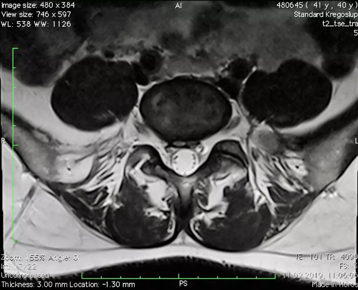 Radiologiczny aspekt gojenia krążka międzykręgowego usg